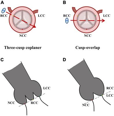 Comparison of cusp-overlap projection and standard three-cusp coplanar view during self-expanding transcatheter aortic valve replacement: A systematic review and meta-analysis